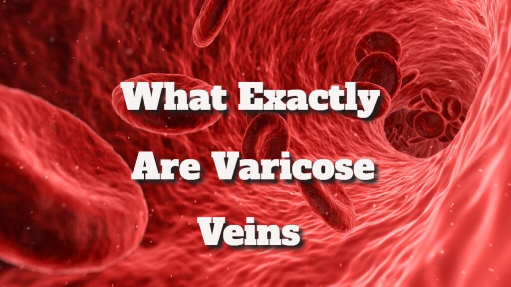 what exactly are vericose veins