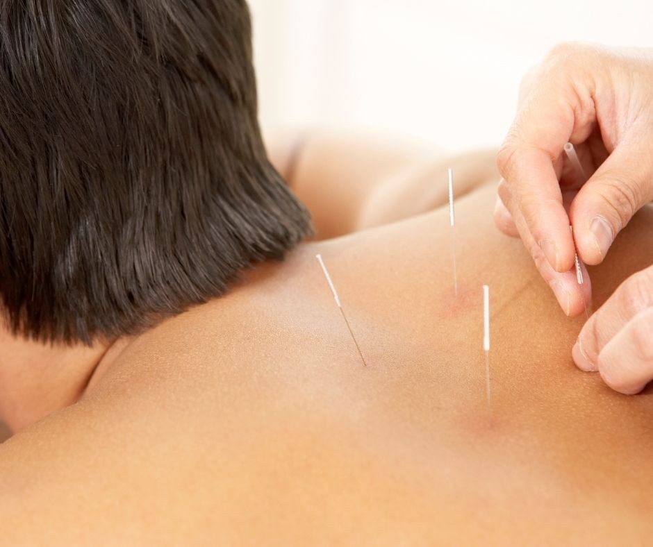 Sports Recovery Treatments with Acupuncture and Cupping